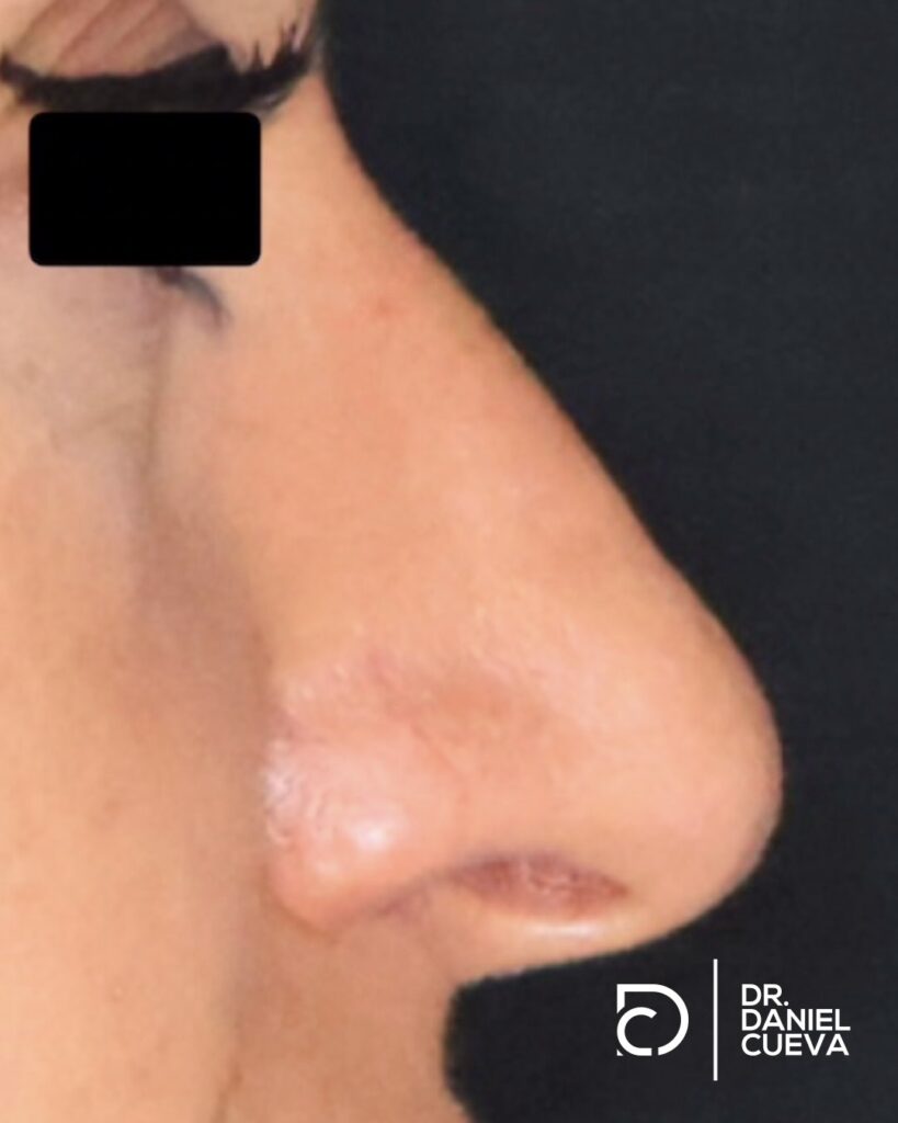 Rinoplastia.fotografias.001