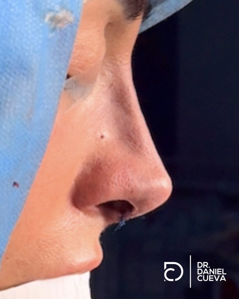 Rinoplastia.fotografias.002