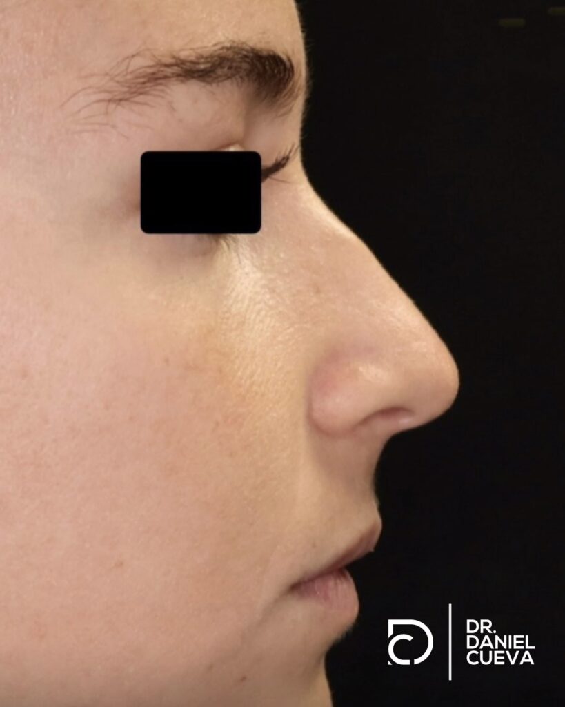 Rinoplastia.fotografias.003