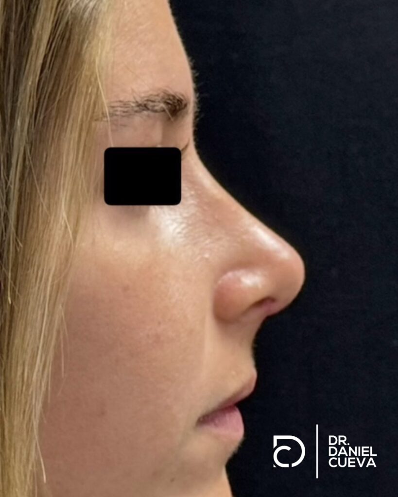 Rinoplastia.fotografias.004