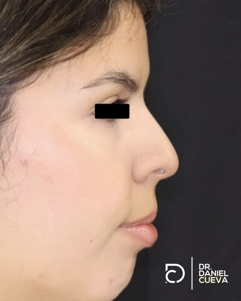 Rinoplastia.fotografias.005
