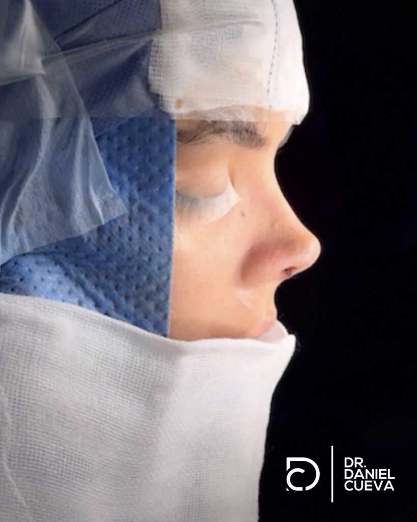 Rinoplastia.fotografias.006