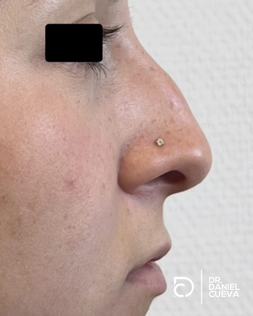 Rinoplastia.fotografias.007