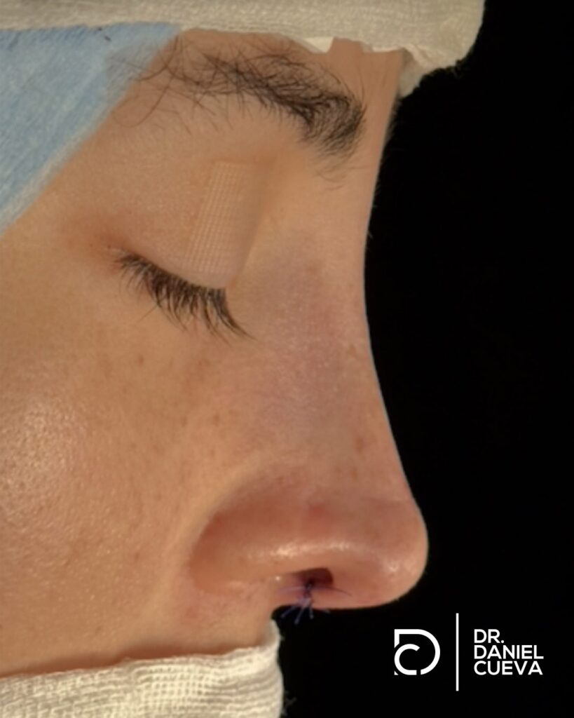 Rinoplastia.fotografias.008