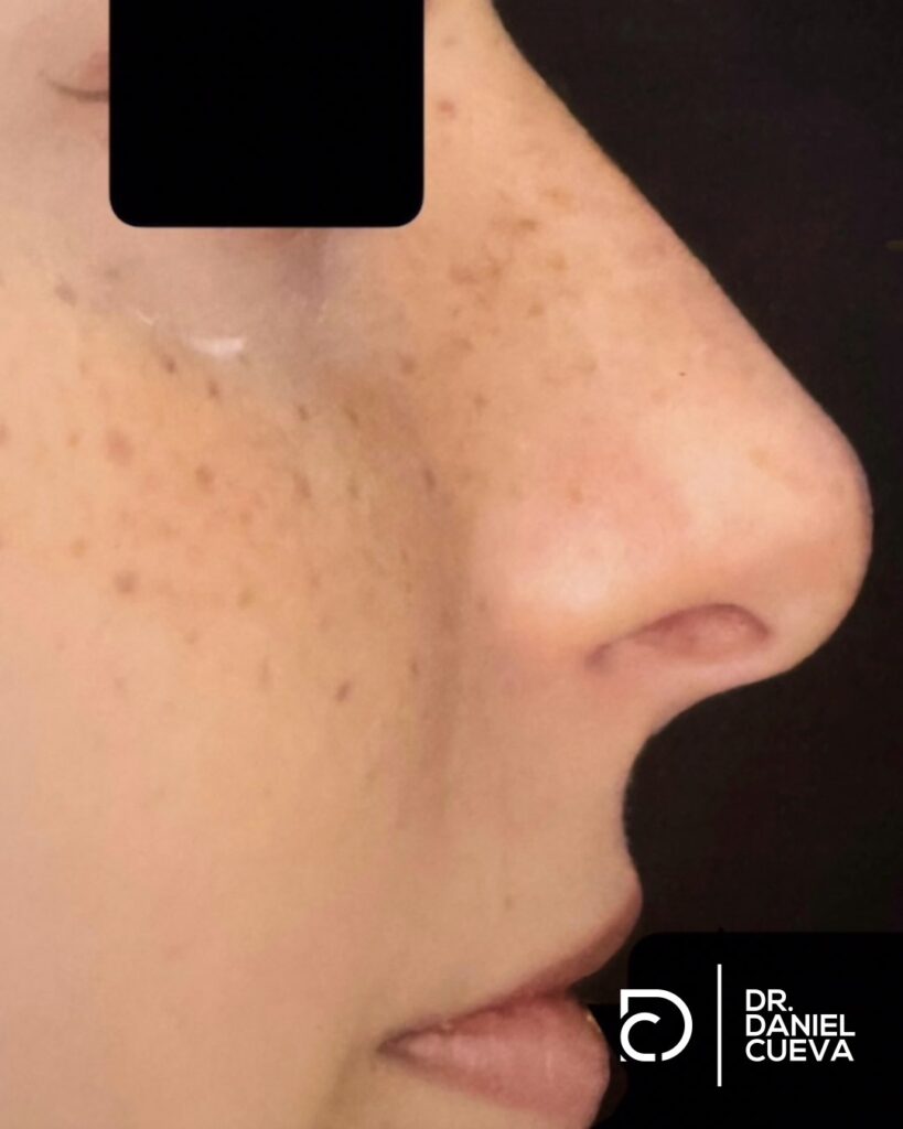 Rinoplastia.fotografias.009