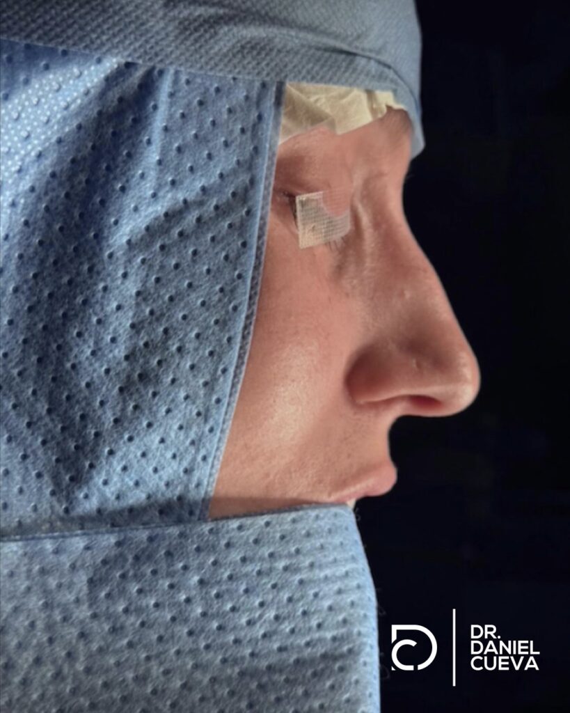 Rinoplastia.fotografias.011