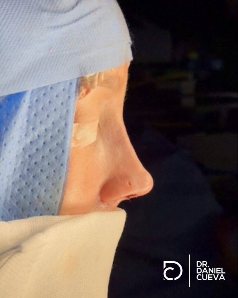 Rinoplastia.fotografias.012